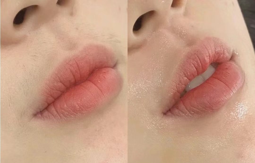 金皇后冰点脱毛