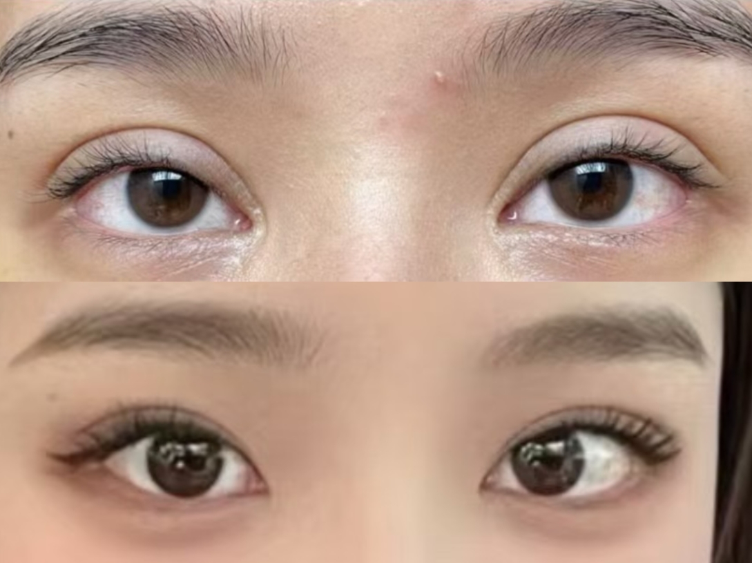 邯郸双眼皮修复手术的效果能维持多久？(图1)